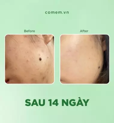 Kem dưỡng ẩm kiềm dầu rau má dành cho da dầu mụn