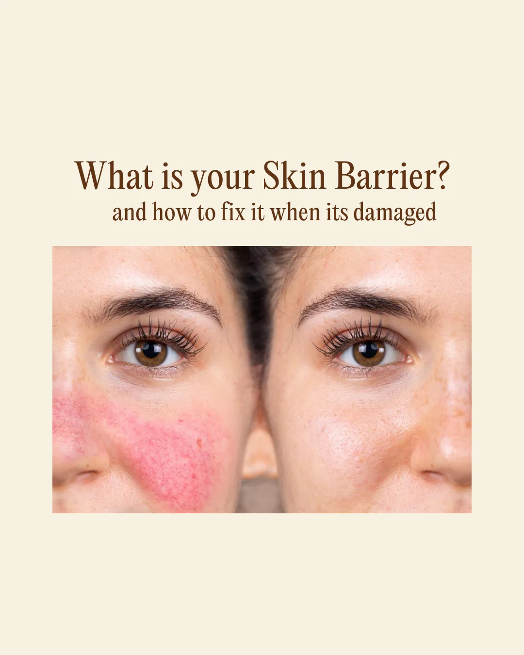 Đánh Thức Làn Da Khỏe Mạnh: Hiểu Về Hàng Rào Bảo Vệ Da (Skin Barrier)